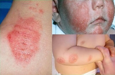 Раздражение под коленками у взрослых и детей