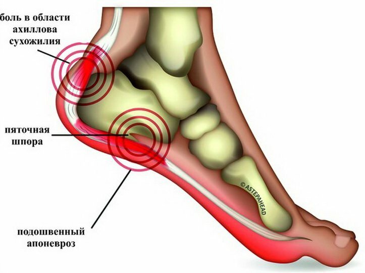 Признаки и лечение подошвенного апоневроза