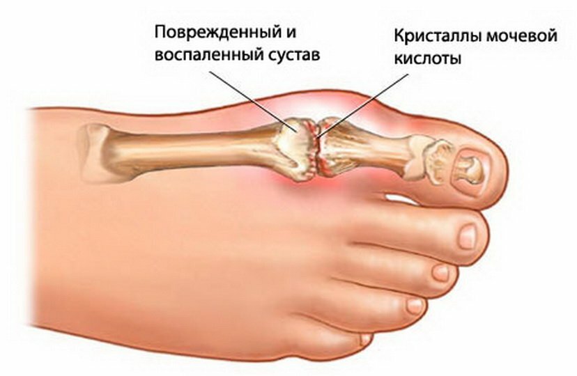 Чем лечить ушиб пальца на ноге?