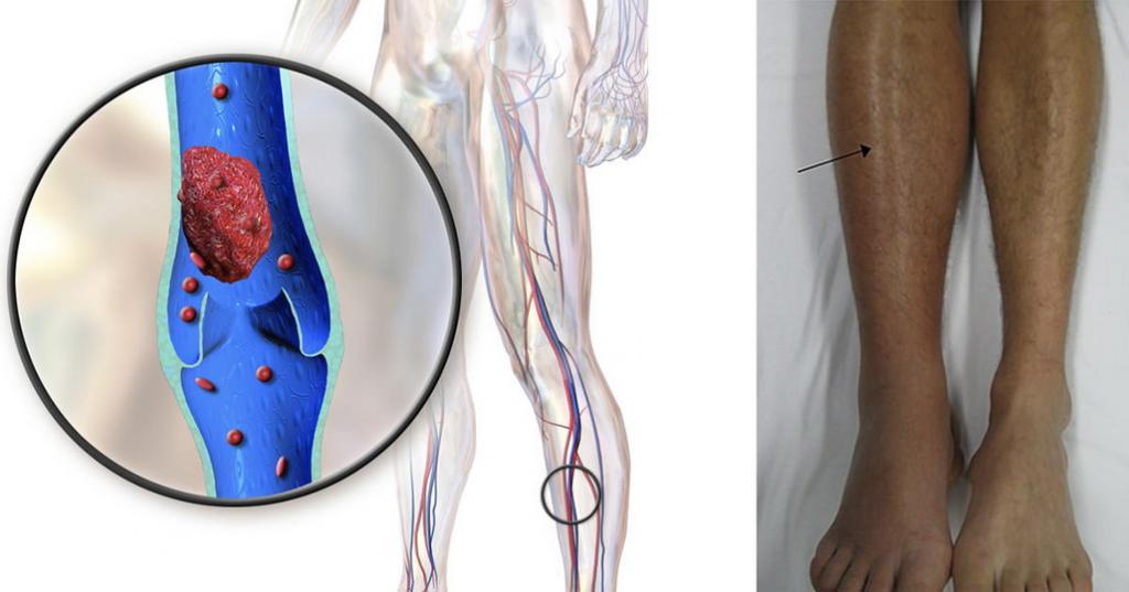 Чем опасен тромбофлебит глубоких вен нижних конечностей для беременных